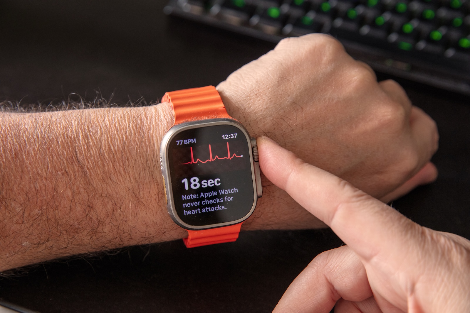 Apple Watch Atrial Fibrillation