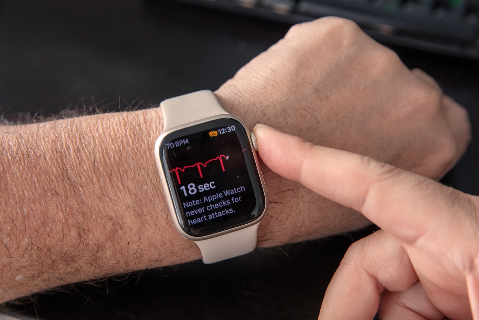 Apple Watch Atrial Fibrillation